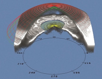 OCULUS_Pentacam_70700_Screen_29_1_01